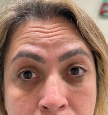 Before: Case 06, Botulinum toxin