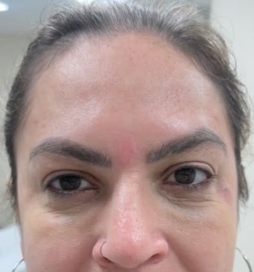 After: Case 06, Botulinum toxin