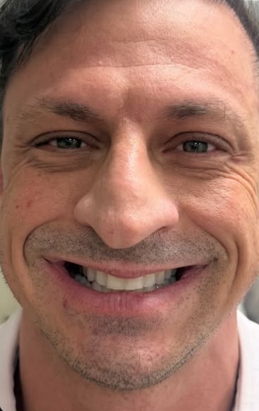 Before: Case 07, Botulinum toxin