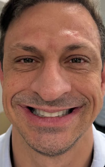 After: Case 07, Botulinum toxin