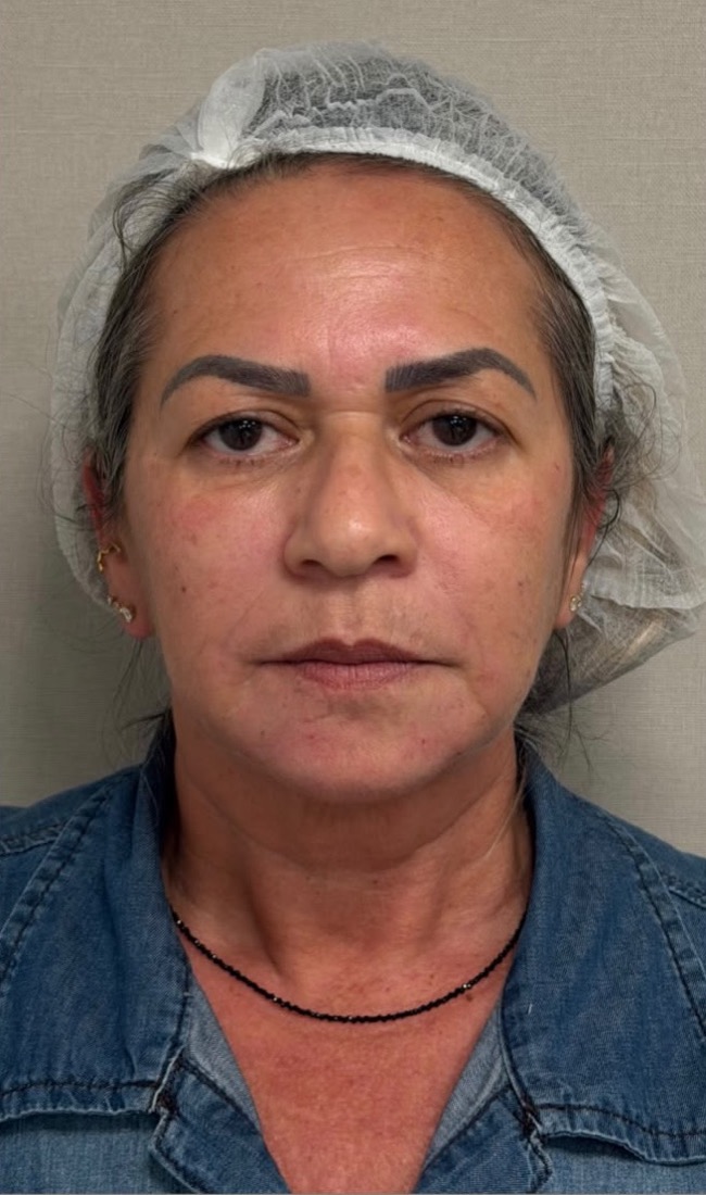 After: Case 01, Face