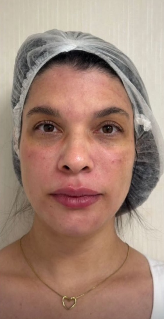 After: Case 03, Face
