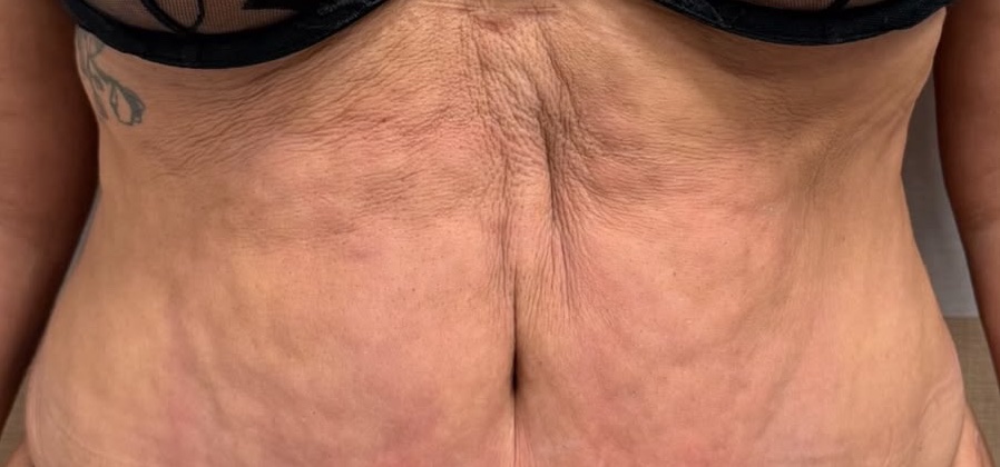 Before: Case 08, Collagen biostimulator