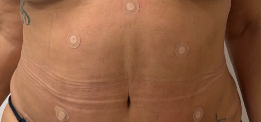 After: Case 08, Collagen biostimulator